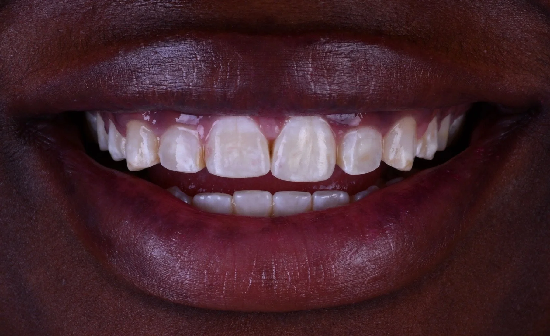 Before & After Porcelain Veneers Miami