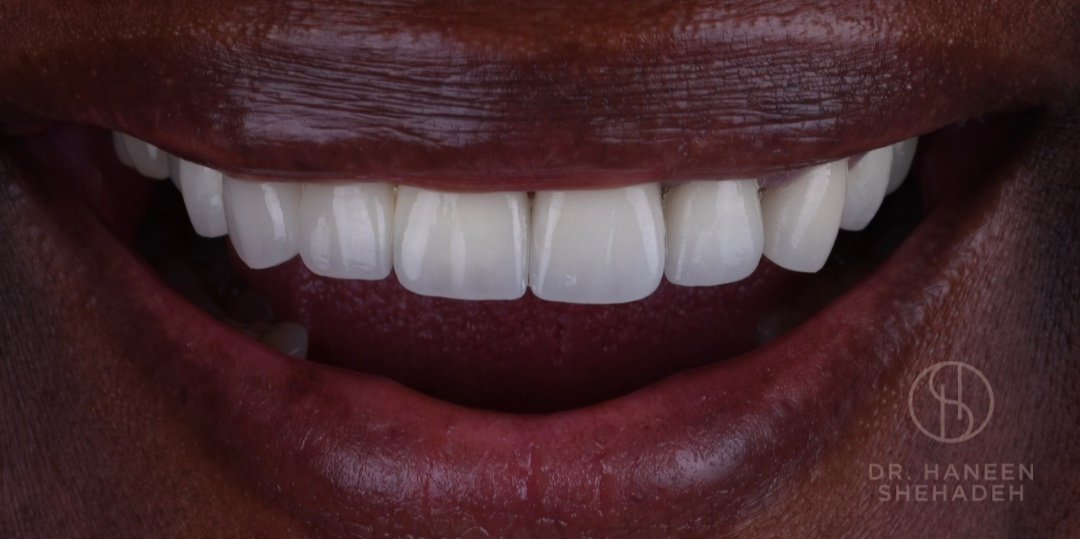 Before and After Porcelain Veneers