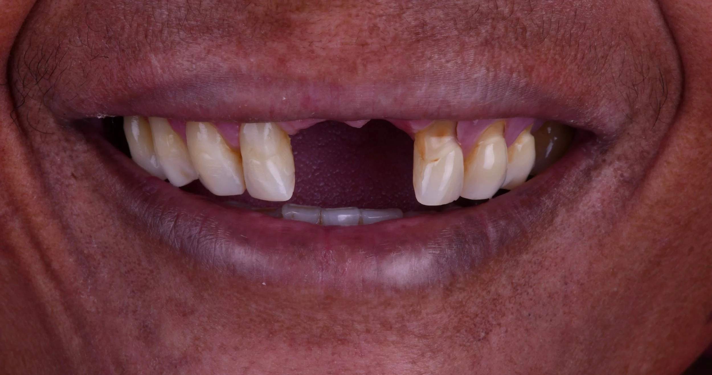 Before and After Implant Dentistry