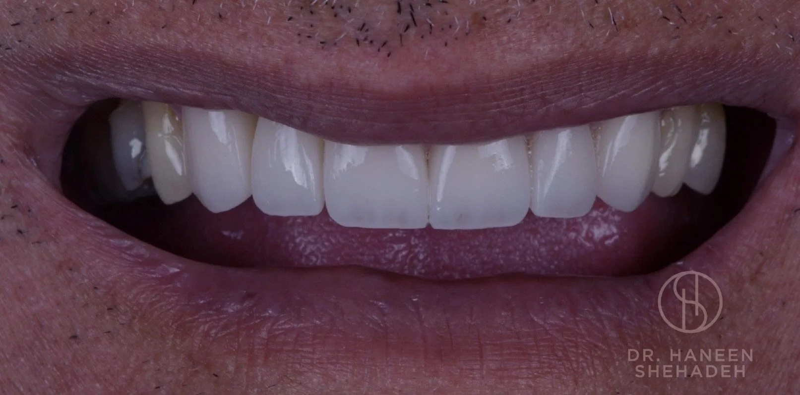 Veneers Before and After