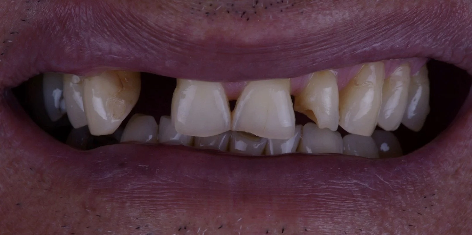 Veneers Before and After