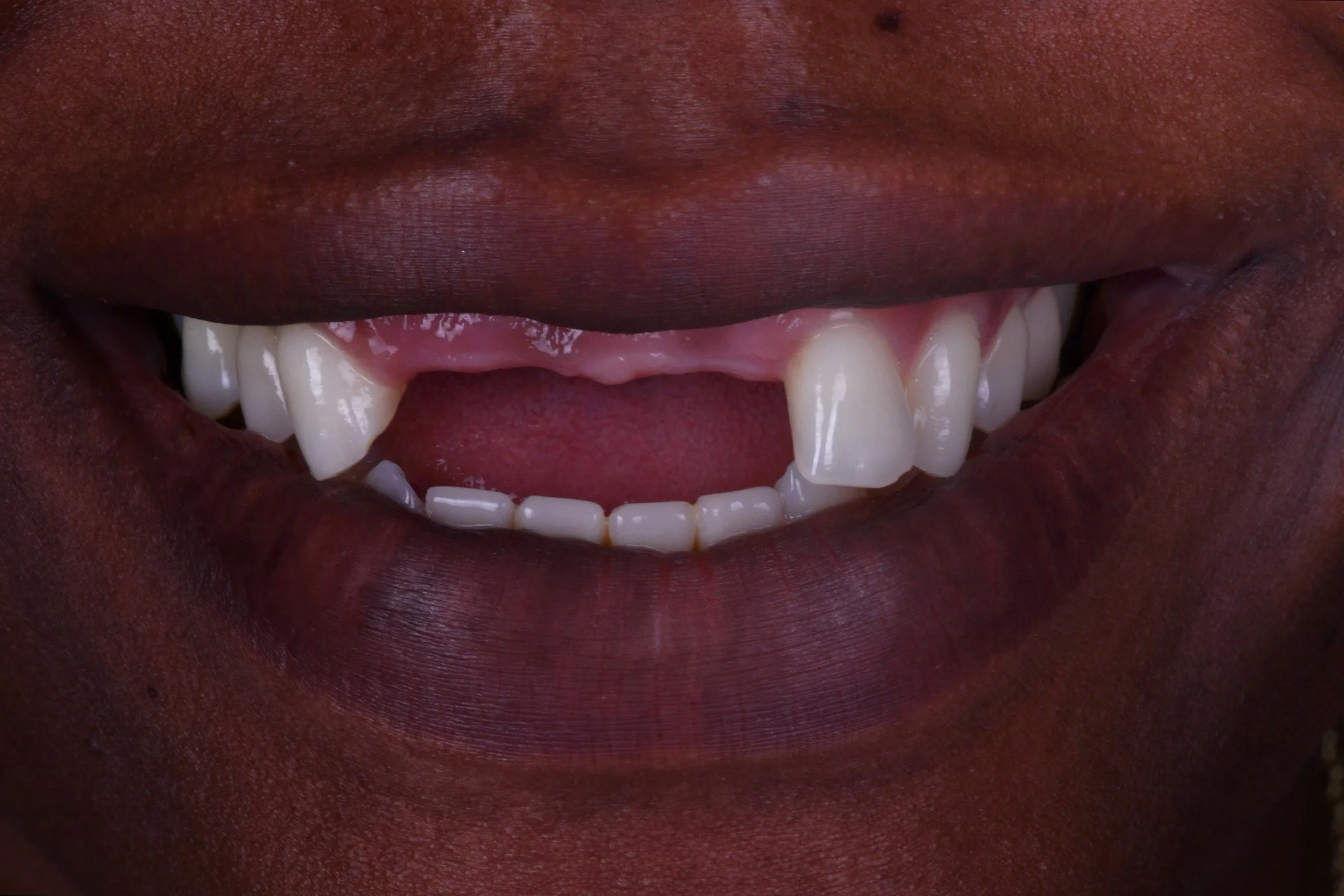 Before & After Porcelain Veneers Fort Lauderdale