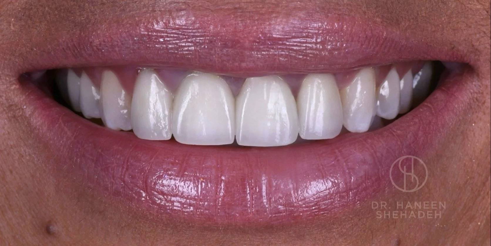 Porcelain Veneers Before & after