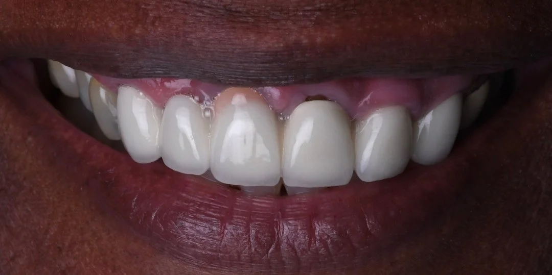 Before and After Porcelain Veneers