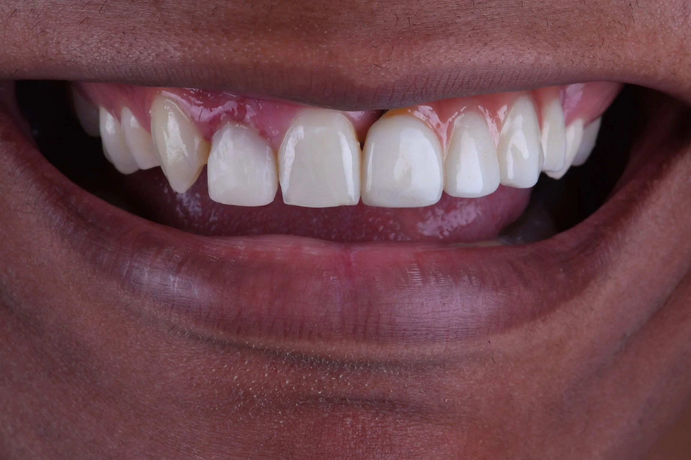 Before & After Porcelain Veneers