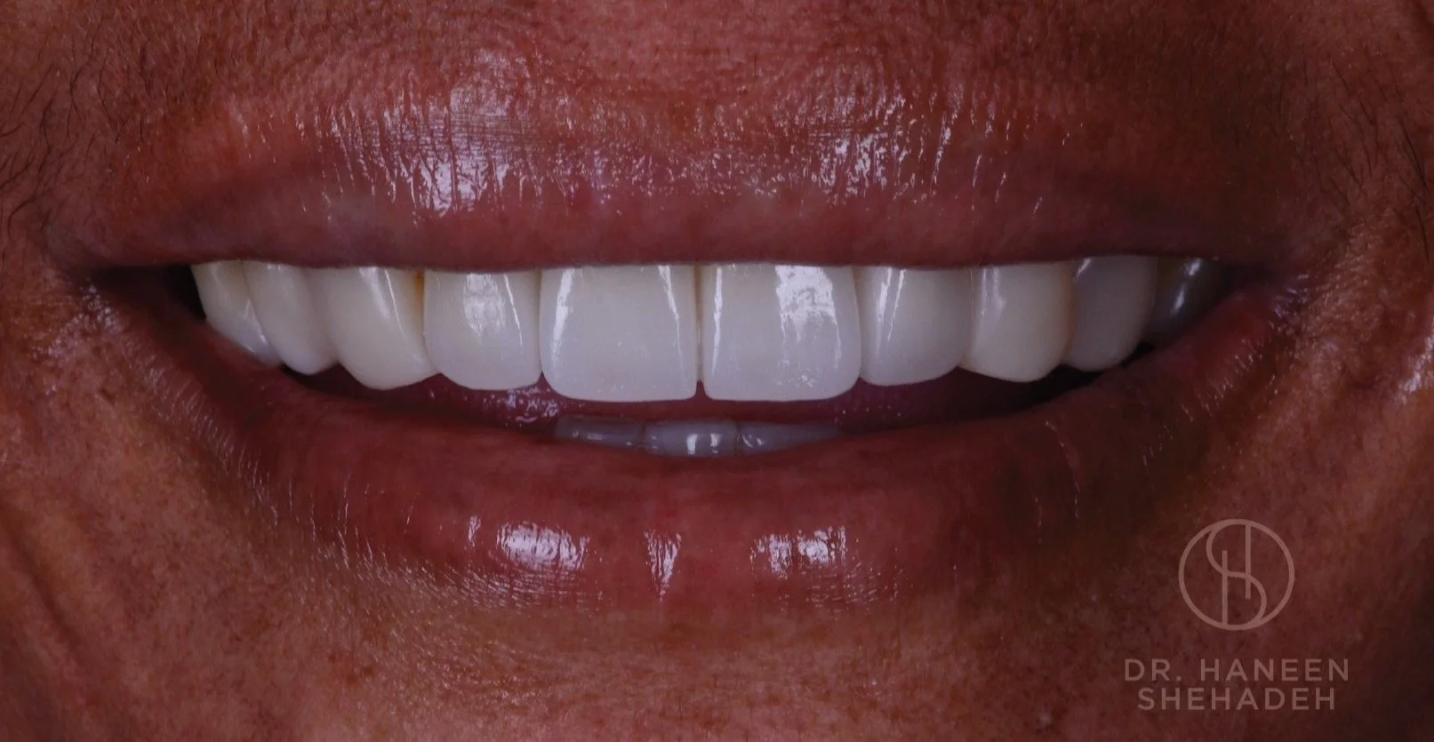 Before and After Implant Dentistry