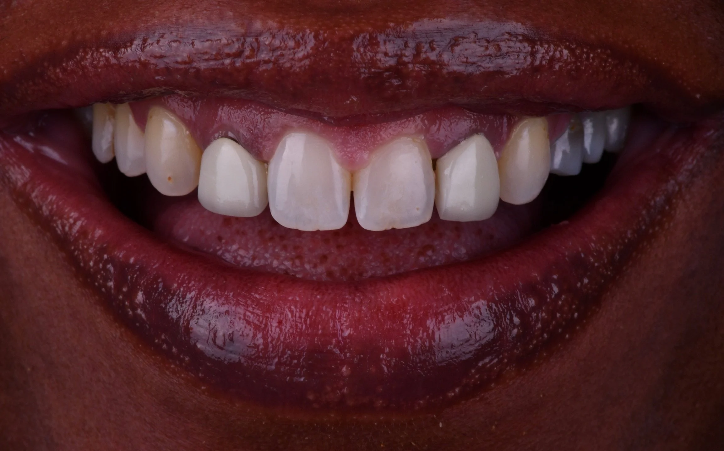 Before and After Porcelain Veneers