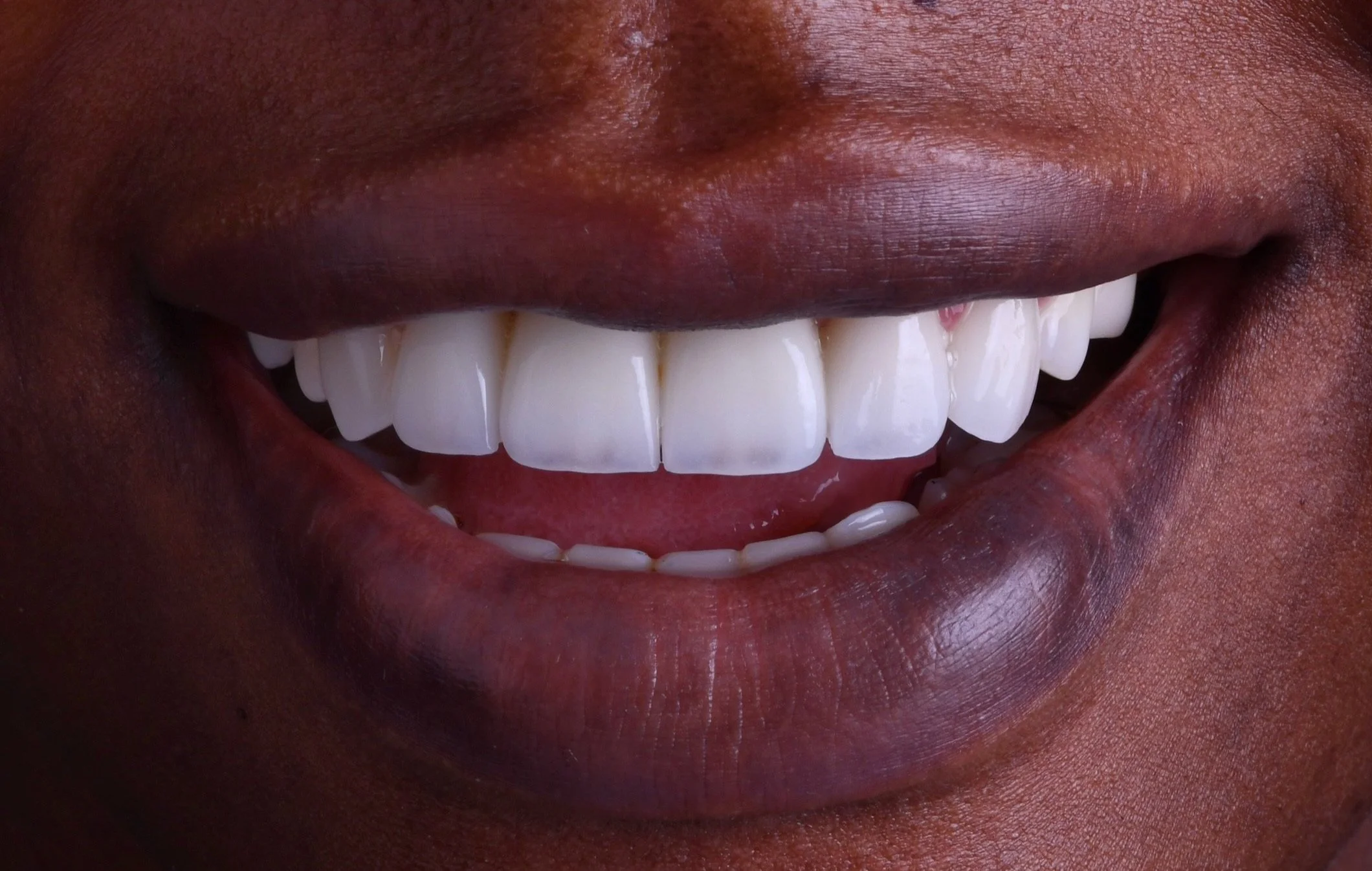 Before & After Porcelain Veneers Fort Lauderdale