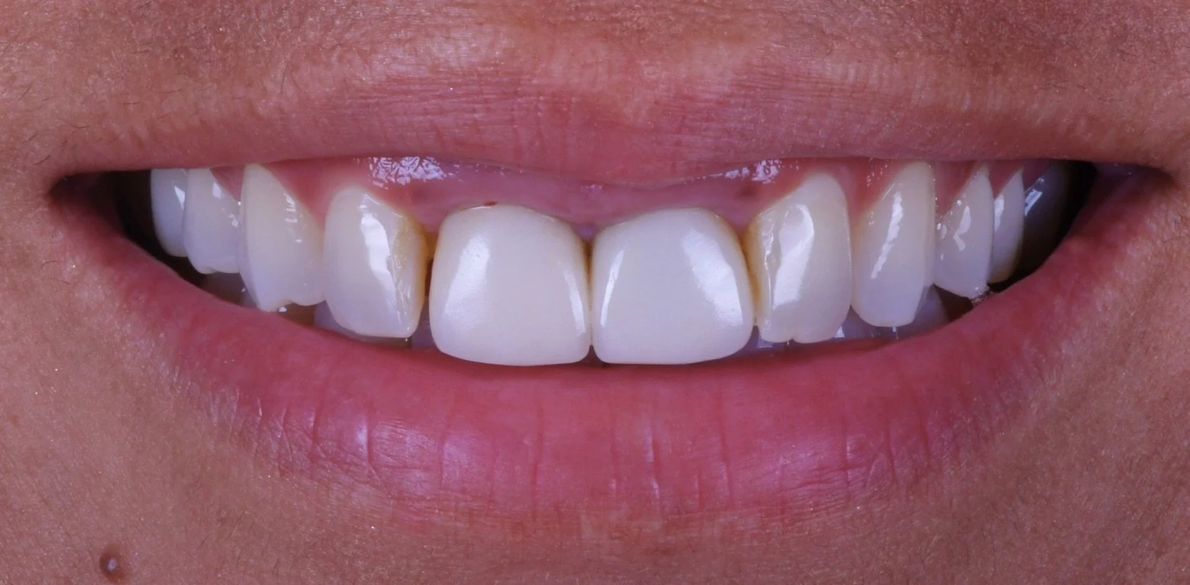 Porcelain Veneers Before & After