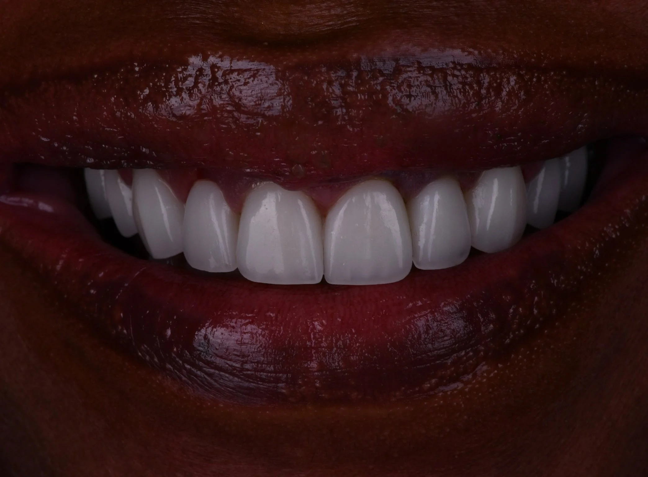 Before and After Porcelain Veneers