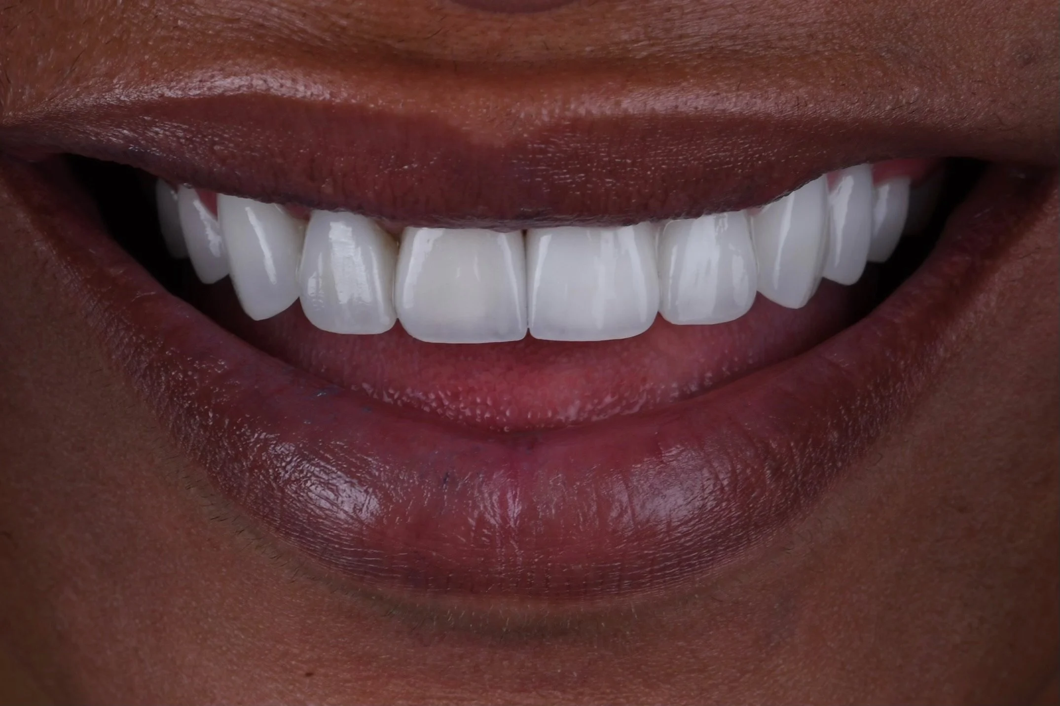 Before & After Porcelain Veneers