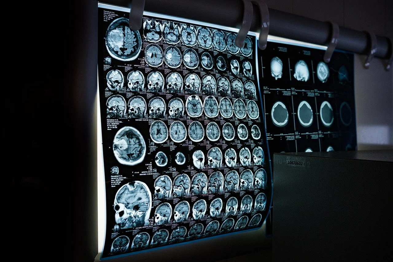 Sleep, Chronic Stress and Alzheimer’s Disease: What the Science Really Shows