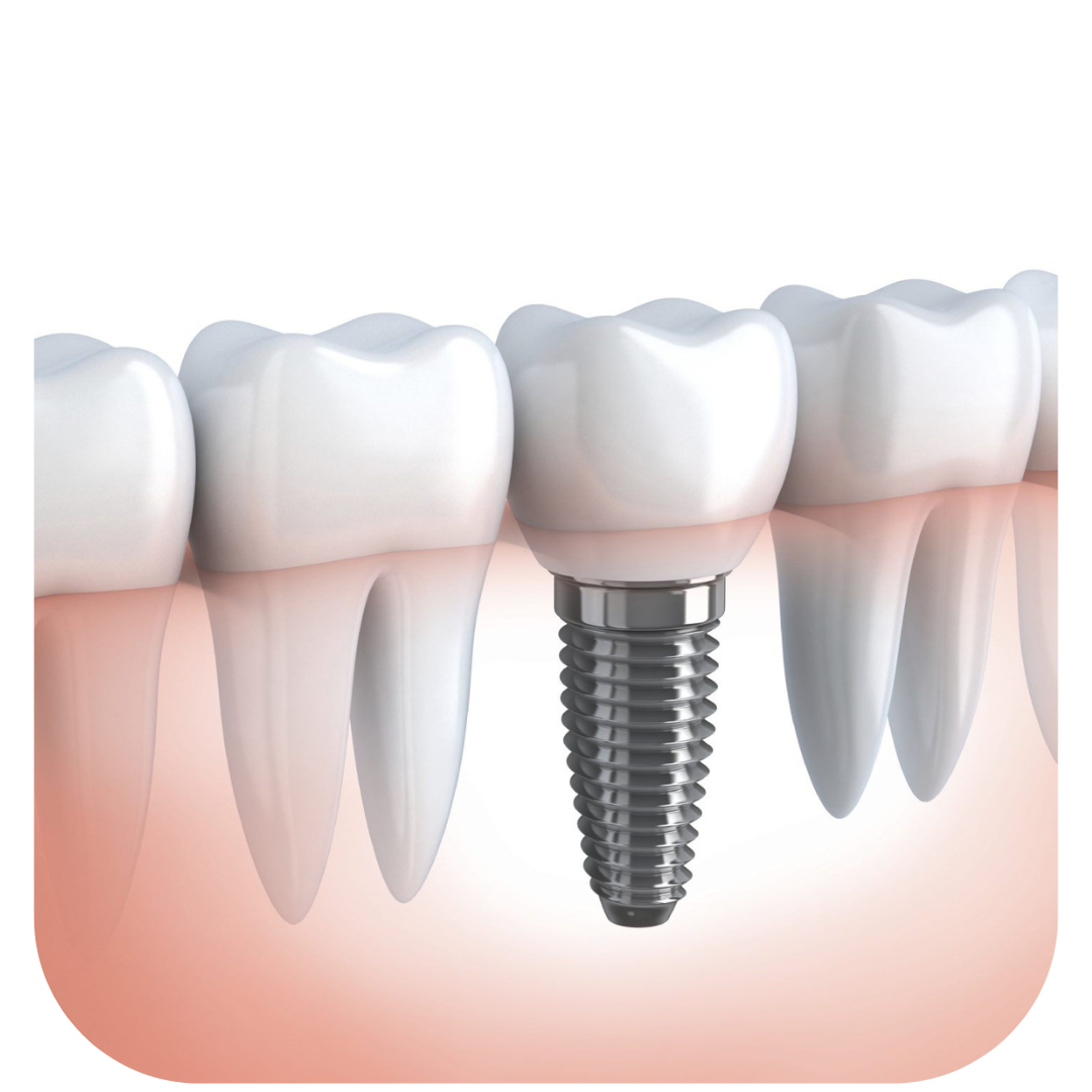 Implante Dentário