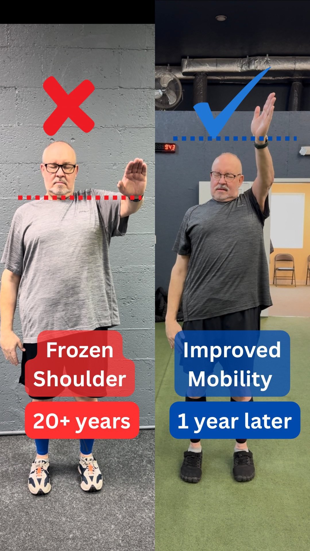 Mark came in with chronic shoulder pain and a frozen shoulder that wouldn’t budge.
He was popping pain pills just to get through the day — for over 20 years, he couldn’t lift his arm above chest height. π€―
Everyone else said there