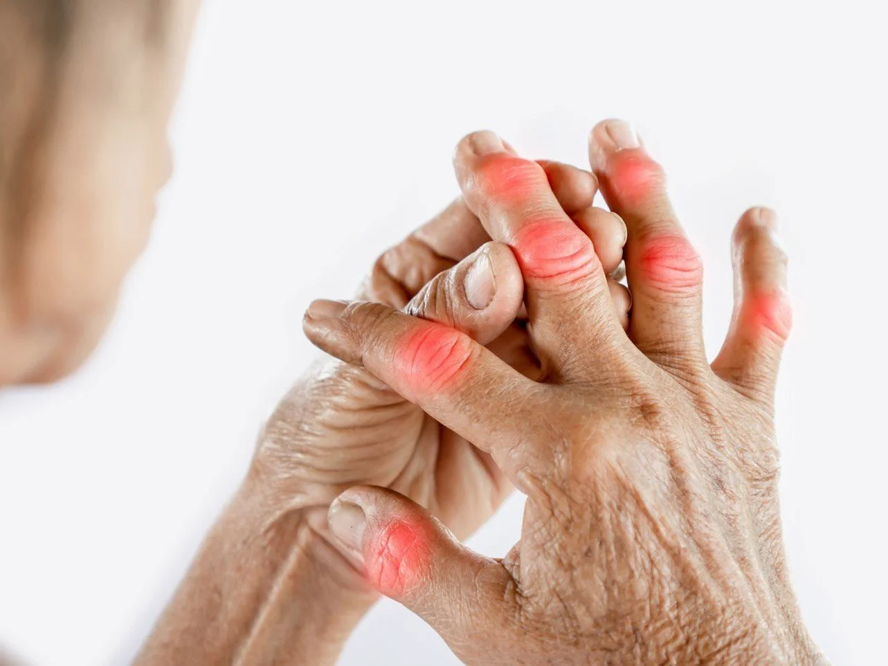 Osteoarthritis
