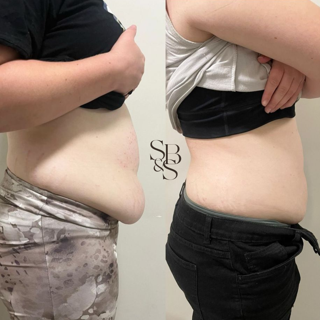 FAT FREEZING PERTH (12).png
