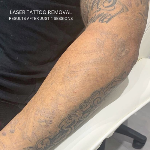 Laser Tattoo Removal results after 4 sessions!