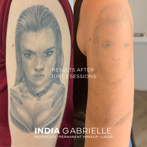Laser Tattoo Removal results after 3 sessions!
