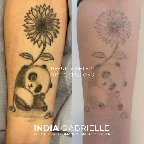 Laser Tattoo Removal results after 2 sessions!