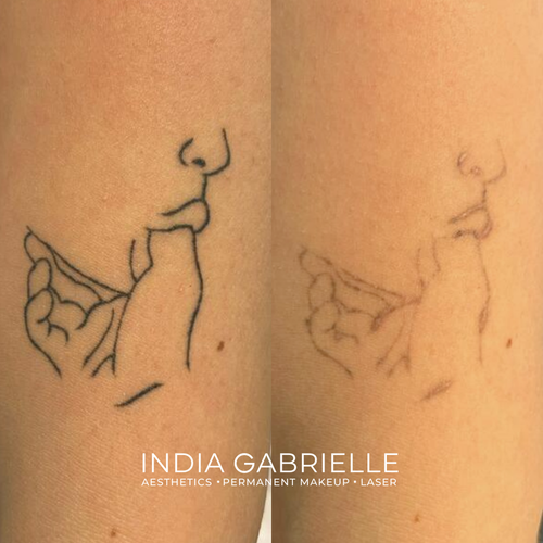 Laser Tattoo Removal results after 4 sessions!