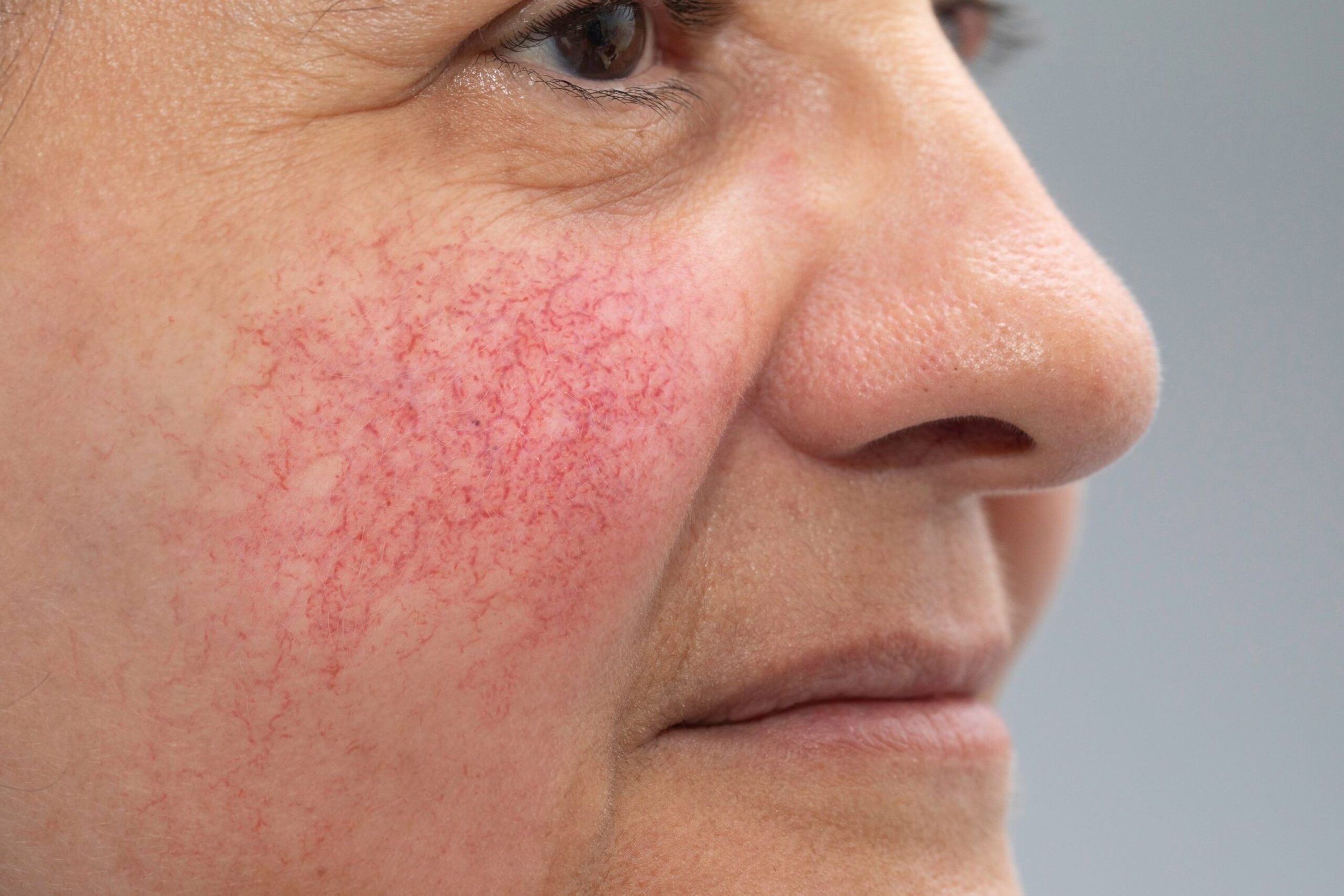 Laser Thread Vein & Rosacea Treatment