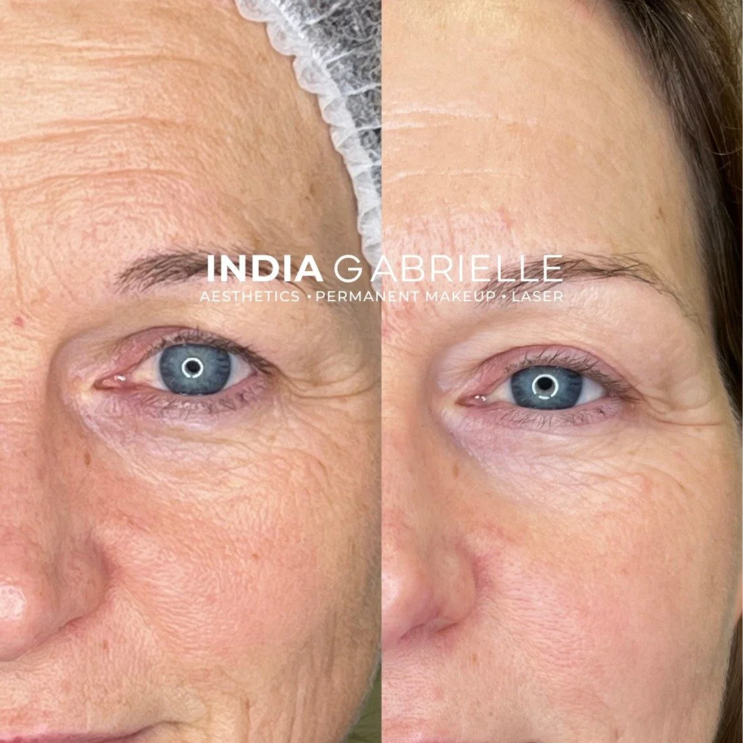 Results after 4 Radiofrequency Microneedling treatments.