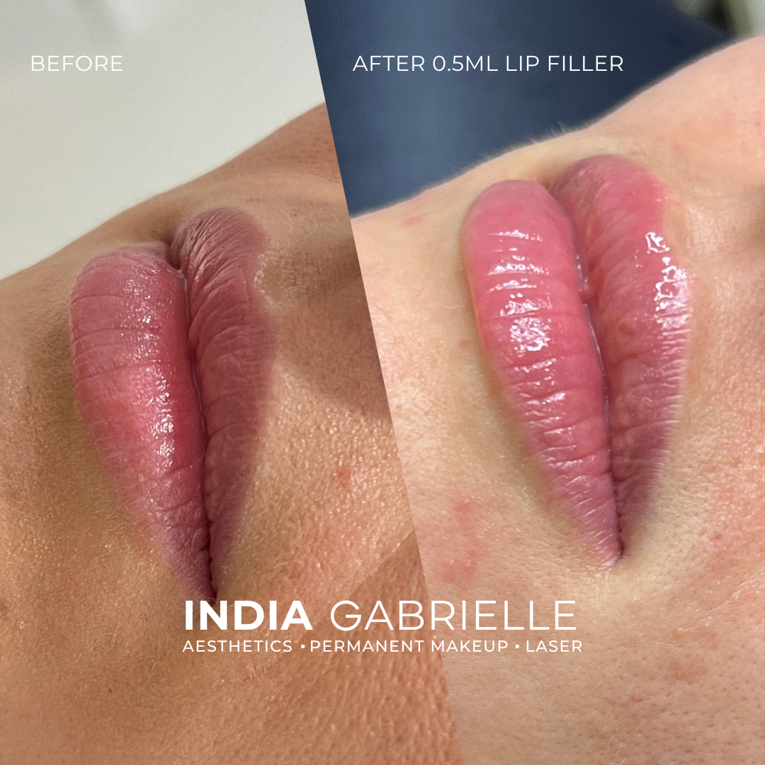 0.5ml Lip Filler by India Gabrielle