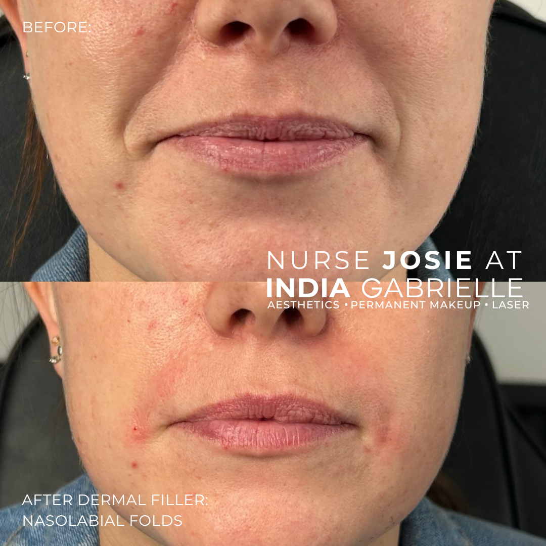 Dermal Filler for Nasolabial Folds by Josie - Advanced Aesthetic Nurse Prescriber