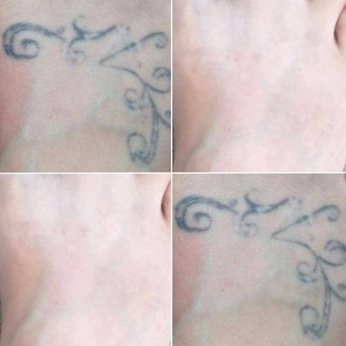 Laser Tattoo Removal results after 4 sessions!