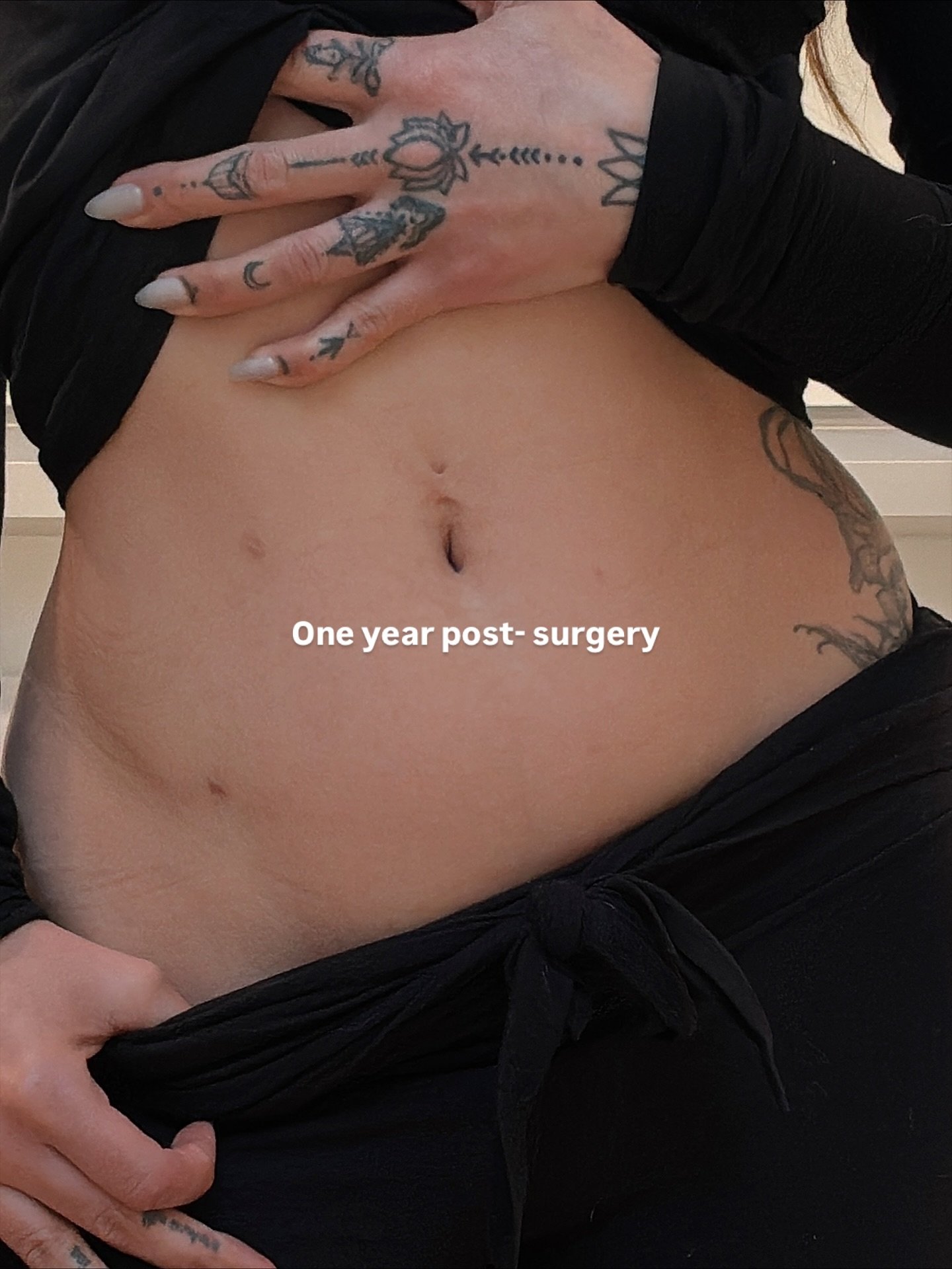 I want to share something deeply personal with you today.

 A year ago yesterday, I had a salpingectomy &mdash; the removal of my fallopian tubes for permanent contraception.

At 37, I knew with absolute certainty that being a mother to humans was no