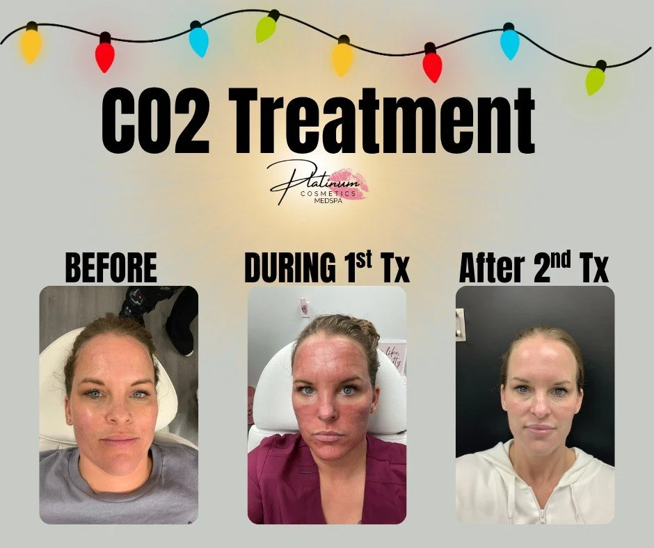 ✨ CO₂ Laser Transformation ✨

Look at this incredible skin journey! ➡️

These photos show our client&rsquo;s skin before any treatment, during her CO₂ session, and after her 2nd treatment&mdash;completed one year apart. The progress is absolutely stu