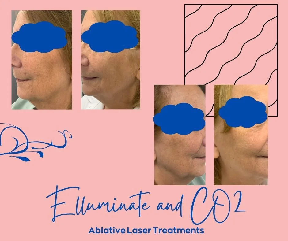 ✨ Ablative Laser Results You Can See ✨
If you&rsquo;re looking for serious skin renewal, our ablative laser treatments deliver powerful, transformative results.

This advanced laser technology helps:
✔️ Tighten and firm the skin
✔️ Reduce pigmentatio