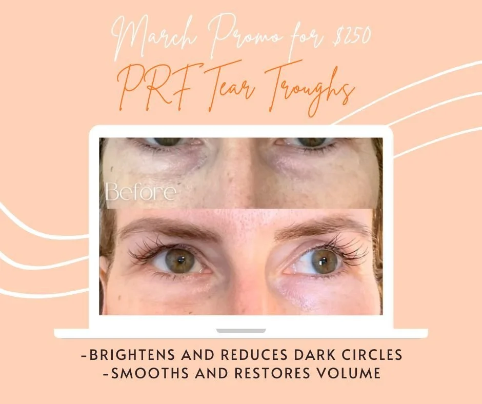 Bright eyes, refreshed look ✨

Our PRF Tear Trough treatment is just $250 for a limited time 🙌

Naturally brighten dark circles, smooth hollowness, and look more rested &mdash; using your body&rsquo;s own growth factors.

Subtle. Natural. No &ldquo;