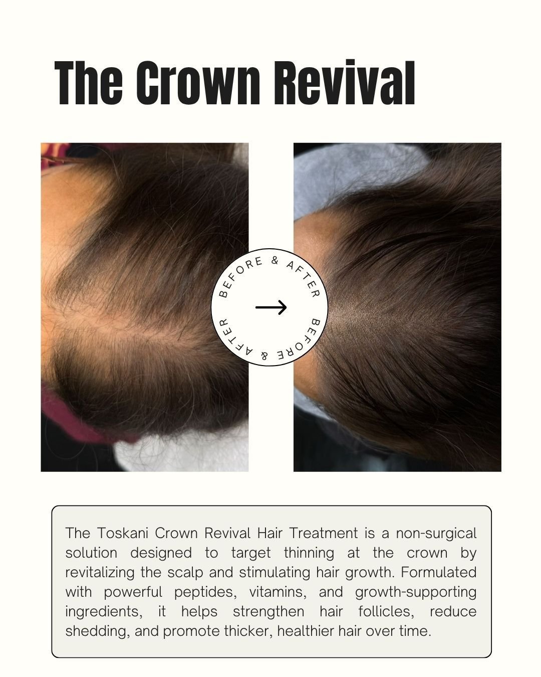 Thinning at the crown? We&rsquo;ve got you ✨
The Crown Revival Hair Treatment is designed to restore, strengthen, and stimulate real growth&mdash;no surgery, no downtime.

Real results. Real confidence.
Call or book your appointment today 💕