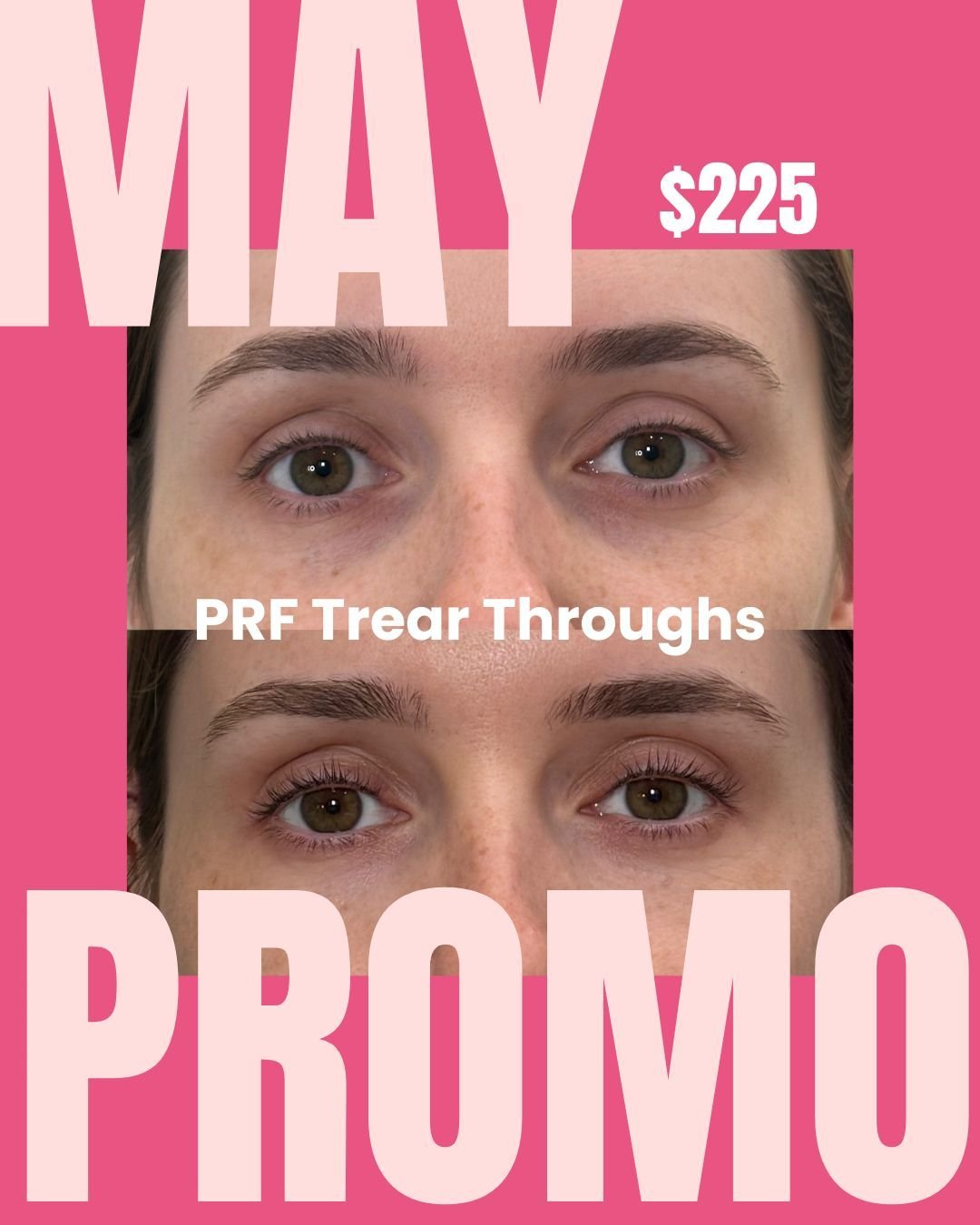 MAY PROMO 🌸

💉 PRF Tear Troughs &ndash; $225

Refresh tired eyes and restore a natural, youthful look 🤍
📞 320.639.1230