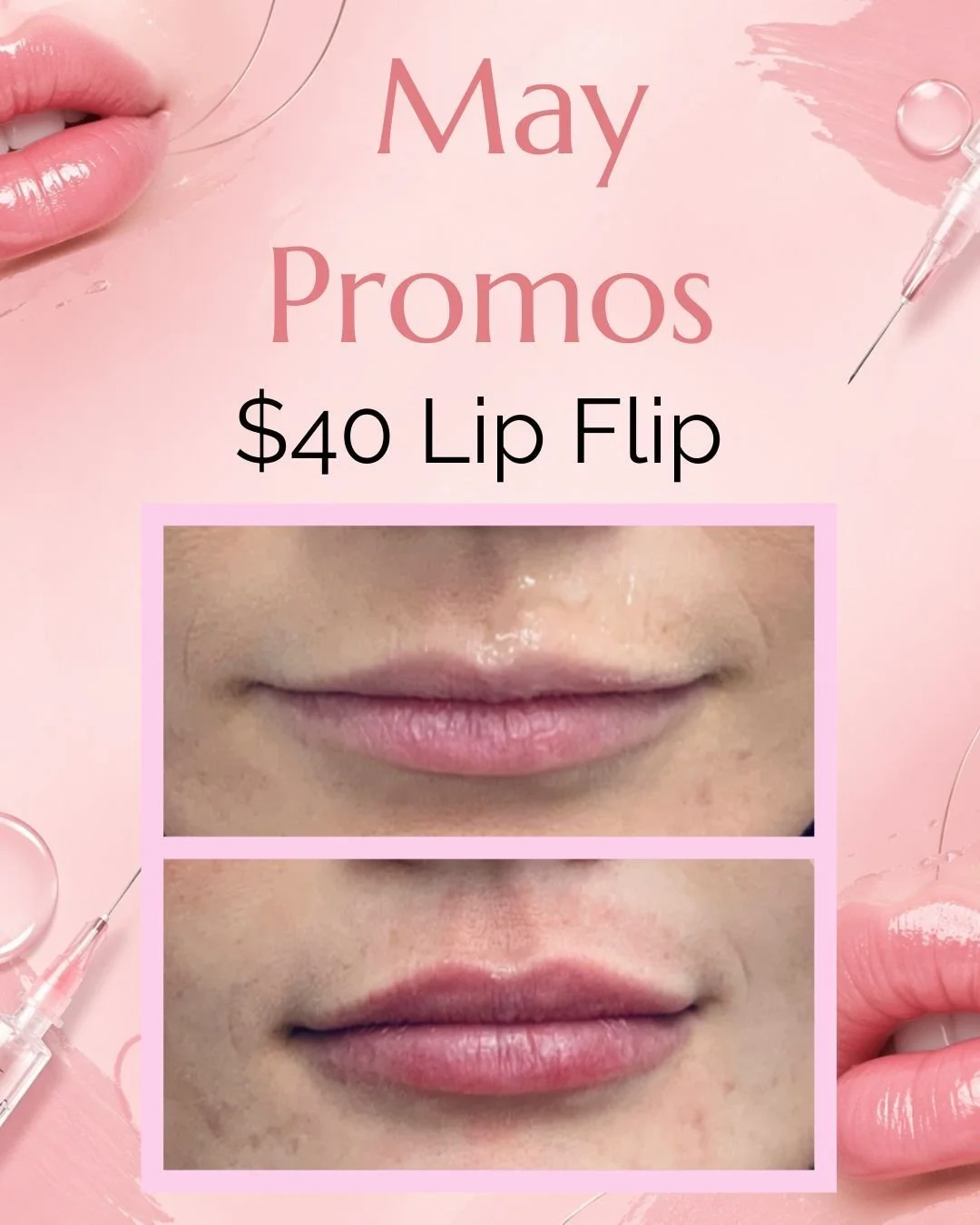 MAY PROMO 🌸

💉 Lip Flip &ndash; $40

Subtle lift, natural results 🤍
📞 320.639.1230