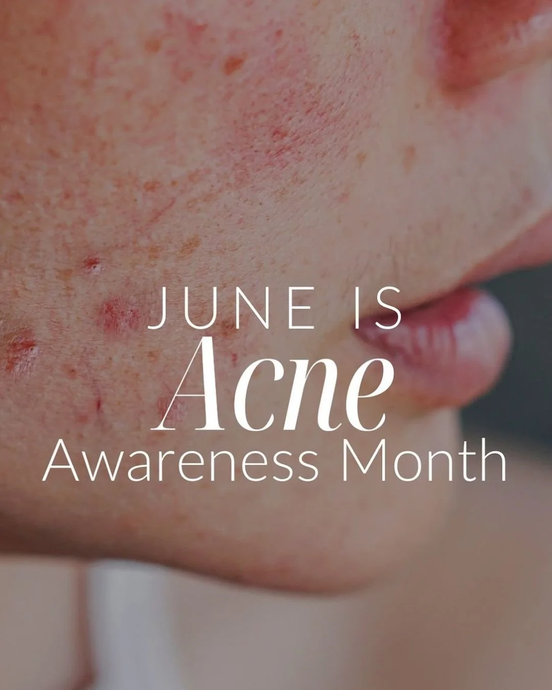 June is Acne Awareness Month 🤍✨

Acne is one of the most common skin concerns &mdash; and a reminder that breakouts don&rsquo;t define your beauty 👏

Whether you struggle with occasional pimples, hormonal acne, or acne scarring, consistency is key 