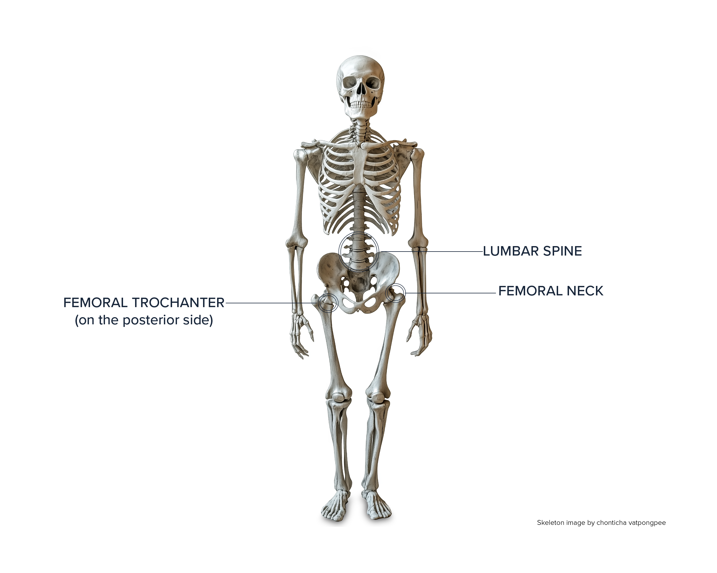 A front-facing human skeleton with the lumbar spine, femoral neck, and femoral trochanter areas identified and labeled.
