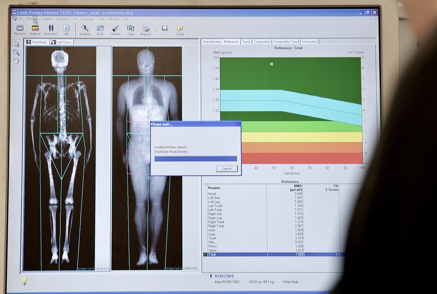 DXA scan bone density report on a computer screen.