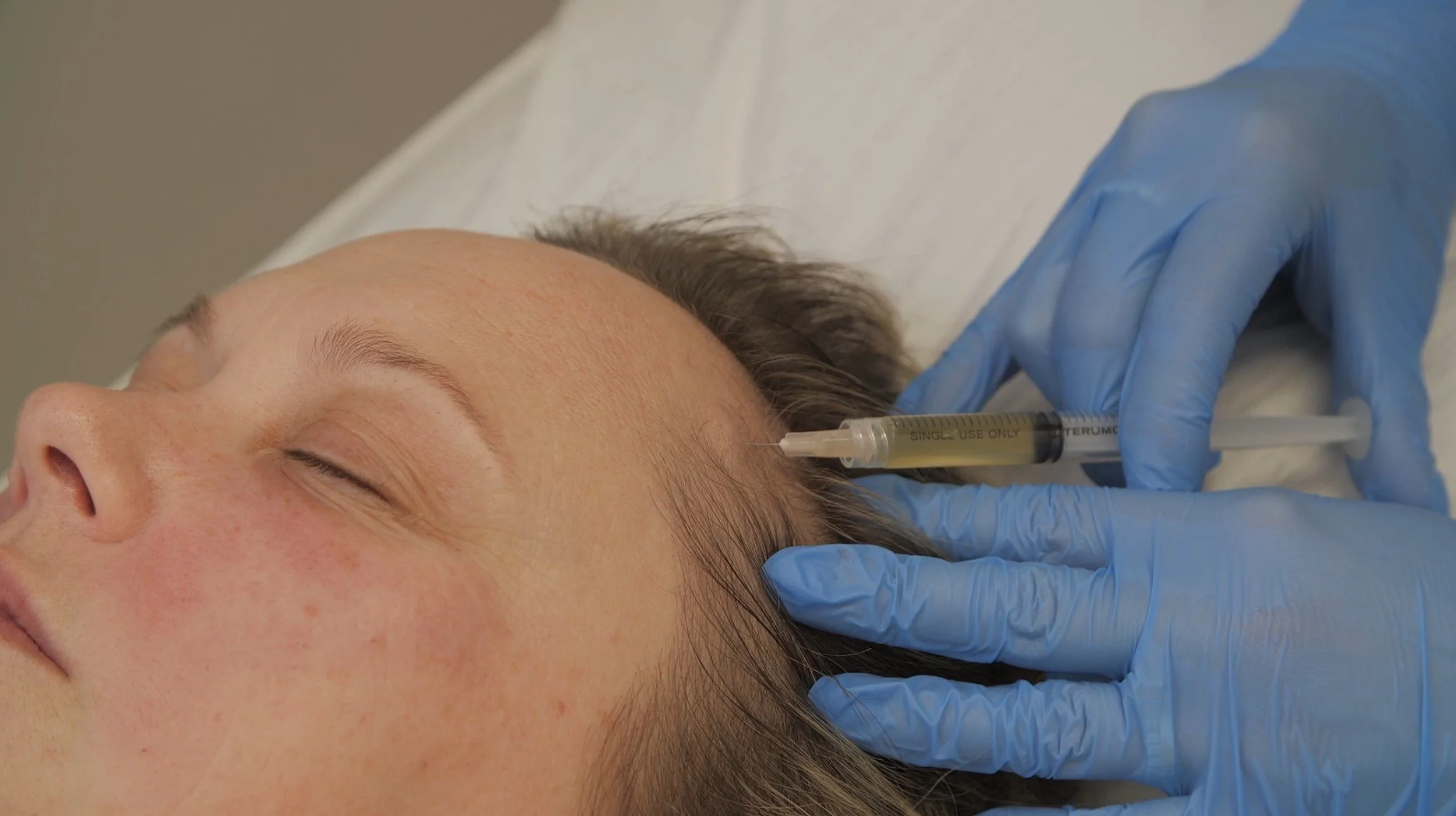 A person receiving a cosmetic procedure (PRP) with a syringe injected near the hairline by a healthcare professional wearing blue gloves.