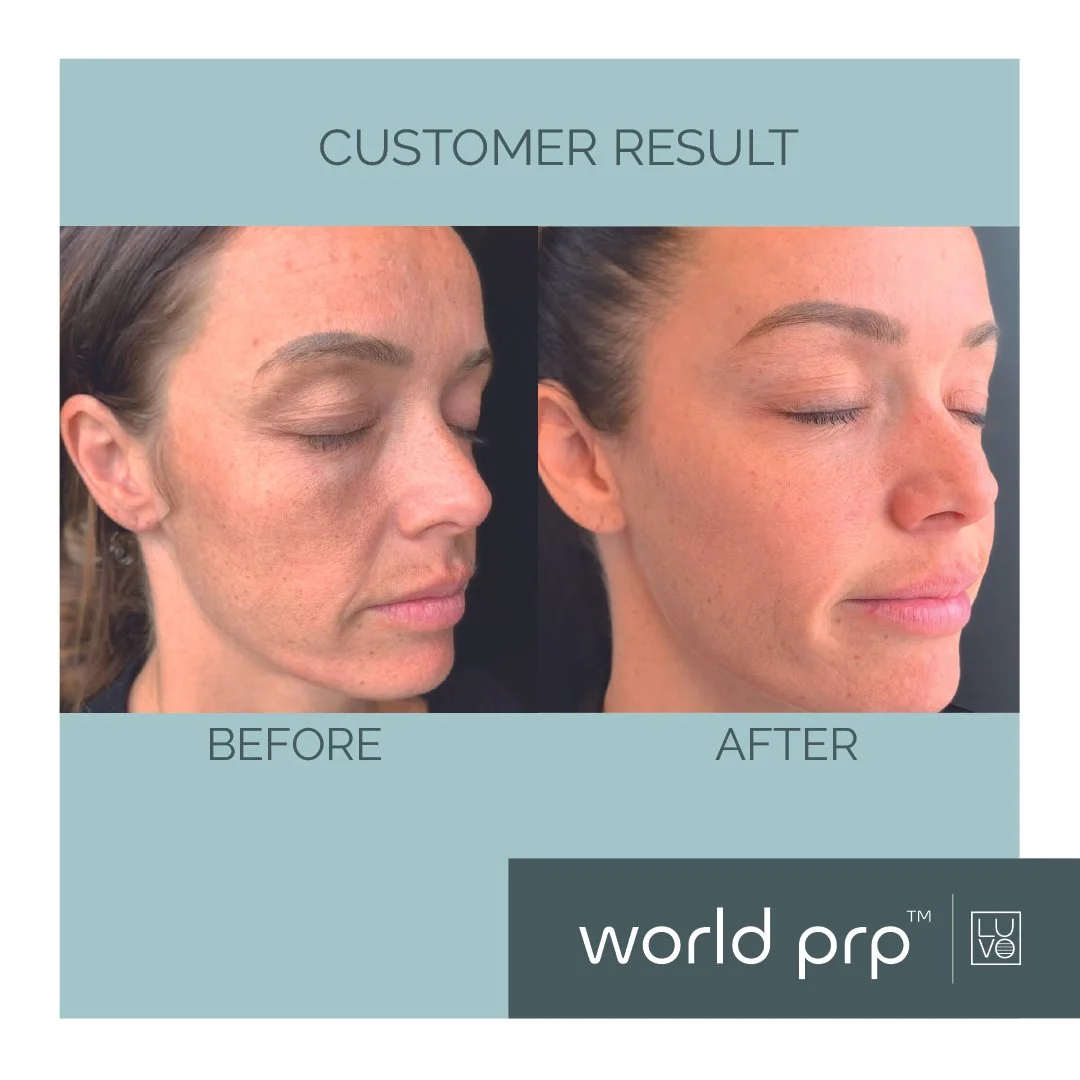 Before and after photos showing the skin improvement of a woman after using PRP treatment.