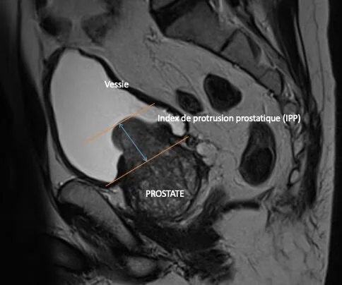 Image montrant une IRM de la région pelvienne mettant en évidence la vessie, la prostate et l'indice de protrusion prostatique (IPP).