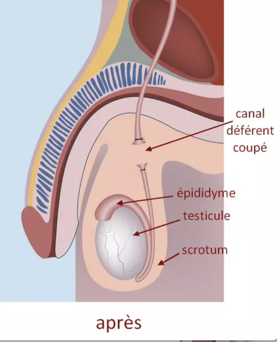 Schéma du système reproducteur masculin après une vasectomie, montrant le canal déférent coupé, l'épididyme, le testicule et le scrotum.