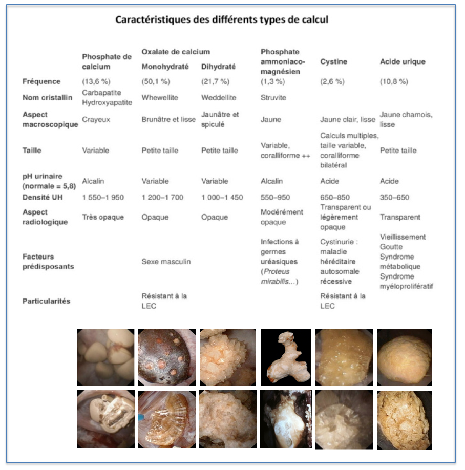 Tableau de caractéristiques de différents types de calculs rénaux, présentant des informations sur la fréquence, l'aspect macroscopique, la taille, le pH urinaire, la densité UH, l'aspect radiologique, les facteurs prédisposants, et les particularités pour chaque type. En bas, des images d'exemples de calculs rénaux sont montrées.