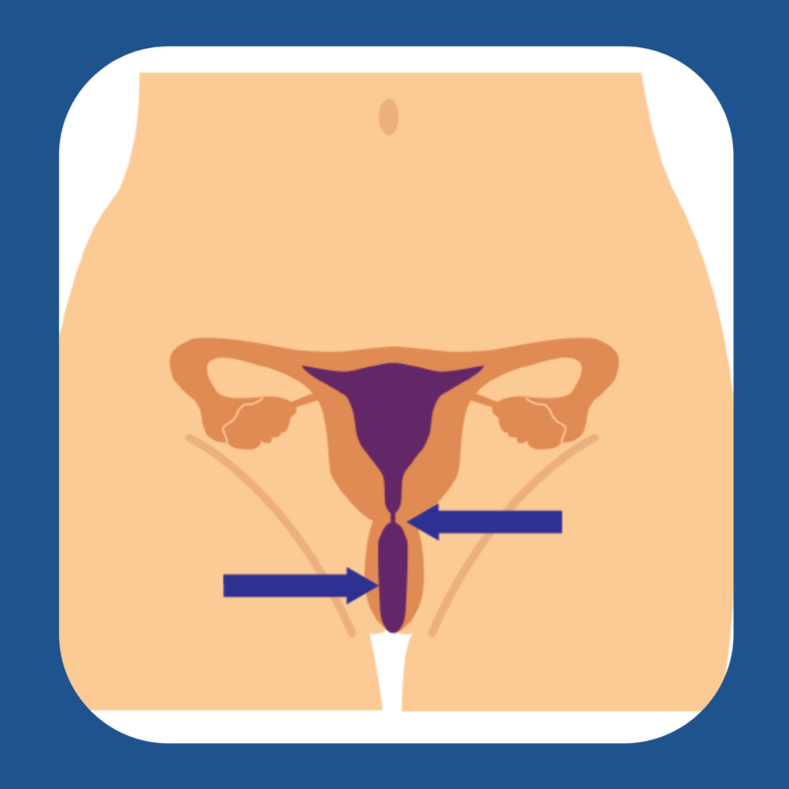 Diagram o anatomeg atgenhedlu benywaidd yn dangos y bledren, y fagina, ceg y groth, a'r groth, gyda saethau'n pwyntio at geg y groth ac agoriad y fagina.