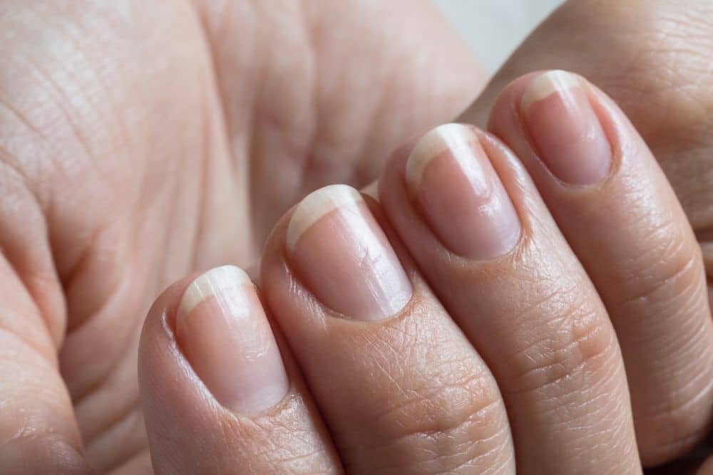 damaged brittle nails
