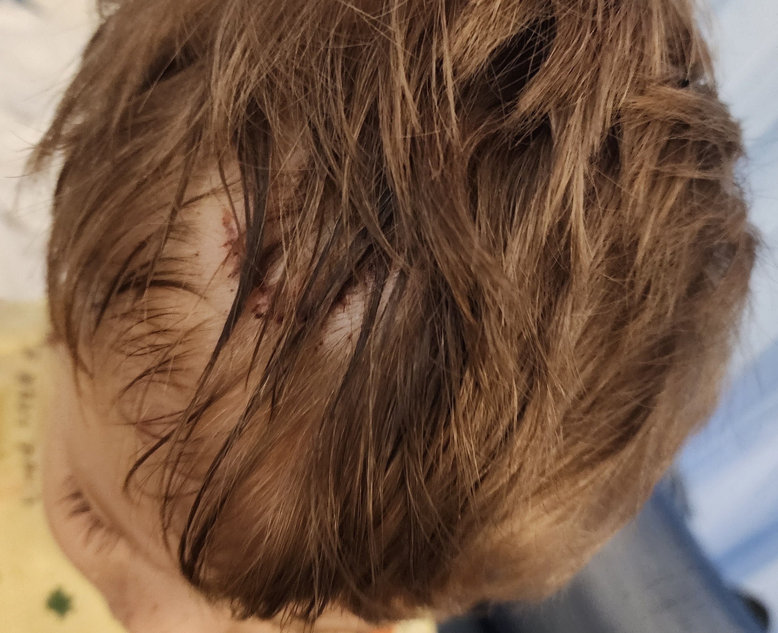 The incision - if you can see it. The surgeon did an excellent job!