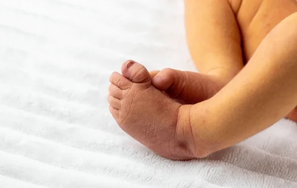 Understanding Infantile Jaundice 