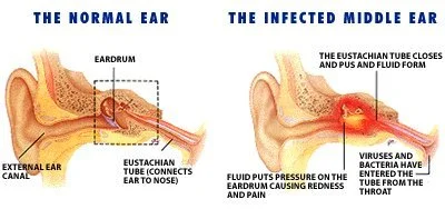 normal-ear-infected-ear.jpg