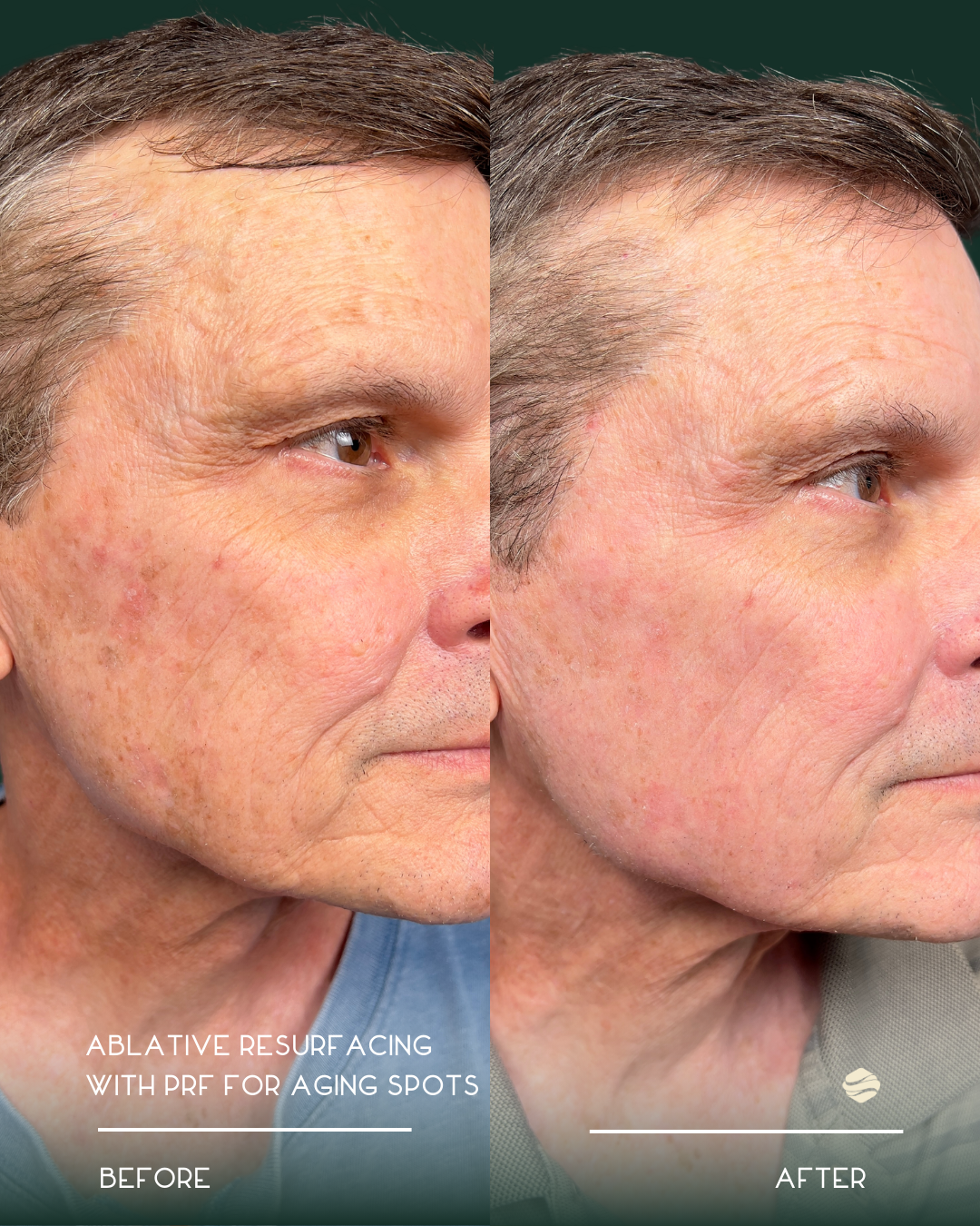 Side-by-side comparison of a man's face before and after ablative resurfacing with PRF for aging spots, showing reduced wrinkles and improved skin texture.